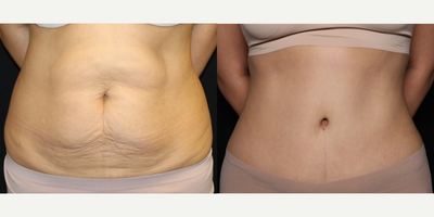 Tummy Tuck before and after photo