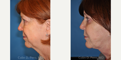 Eyelid Surgery before and after photo