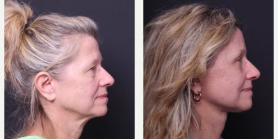 Eyelid Surgery before and after photo