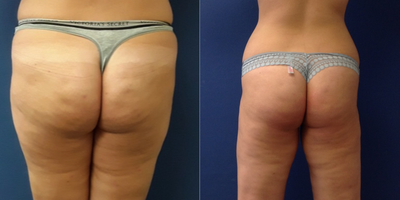 Liposuction before and after photo