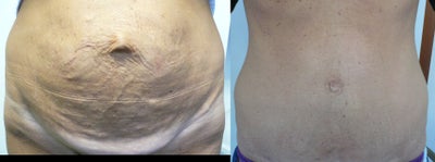 Tummy Tuck before and after photo