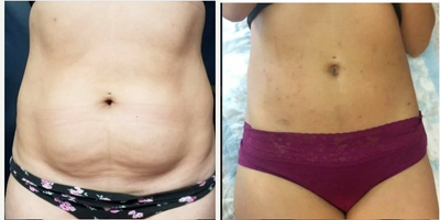 BeautiFill before and after photo