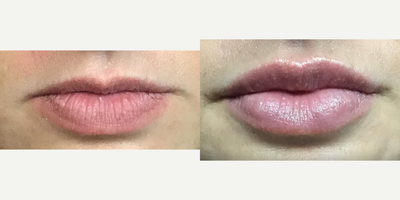 Restylane before and after photo