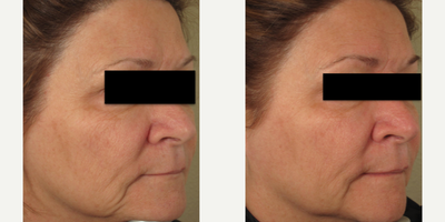 Skin Rejuvenation before and after photo