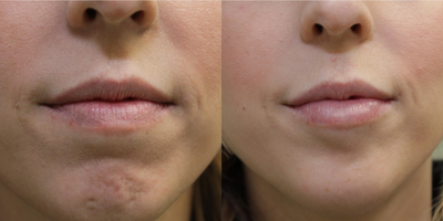 Botox before and after photo