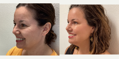 Botox before and after photo