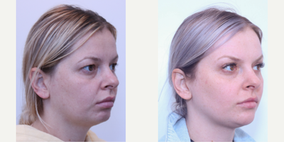 Brow Lift before and after photo