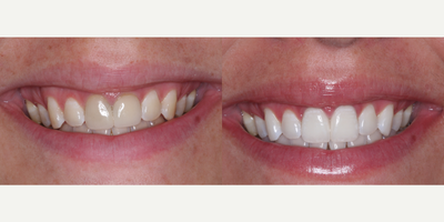 Dental Crown before and after photo