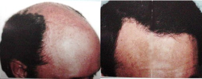 Hair Transplant before and after photo