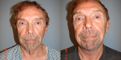 Neck Lift before and after photo