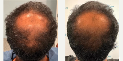 PRP Injections before and after photo