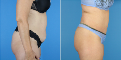 Tummy Tuck before and after photo