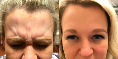 Dysport before and after photo