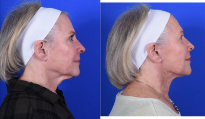 Facelift before and after photo