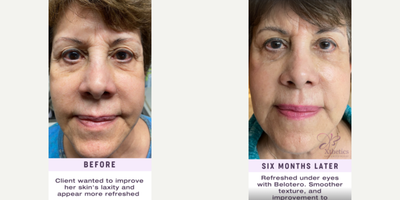 Belotero before and after photo