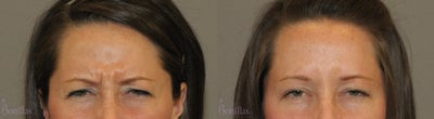 Botox before and after photo