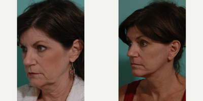 Facelift before and after photo