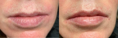 Juvederm before and after photo