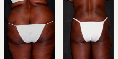 Liposuction before and after photo