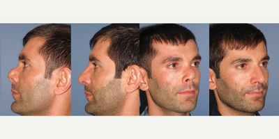 Revision Rhinoplasty before and after photo