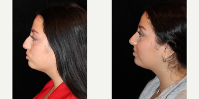 Rhinoplasty before and after photo