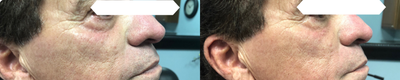 Dermal Fillers before and after photo