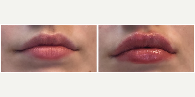 Juvederm before and after photo