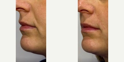 Juvederm before and after photo