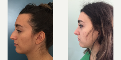 Rhinoplasty before and after photo