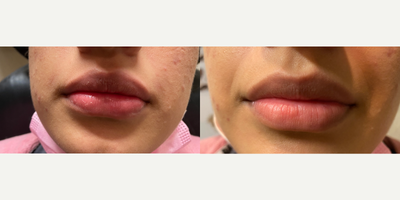 Dermal Fillers before and after photo