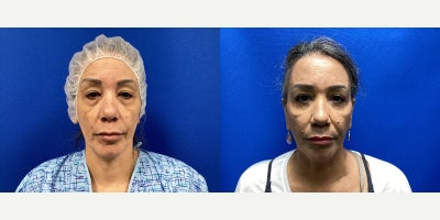 Eyelid Surgery before and after photo