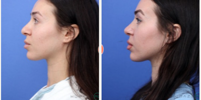 Revision Rhinoplasty before and after photo