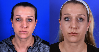 Rhinoplasty before and after photo