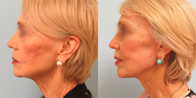 Facelift before and after photo
