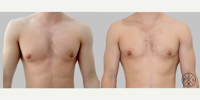 Gynecomastia Surgery before and after photo