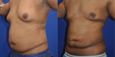 Smart Lipo before and after photo