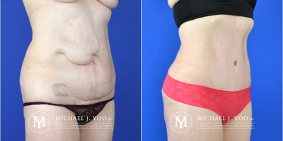 Tummy Tuck before and after photo