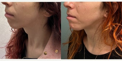 Adam's Apple Reduction before and after photo