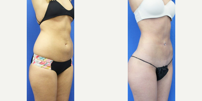 Butt Augmentation before and after photo
