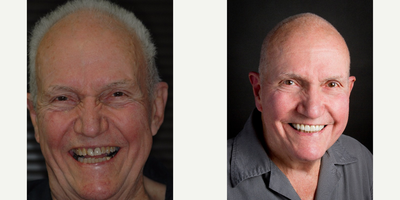 Dental Implants before and after photo