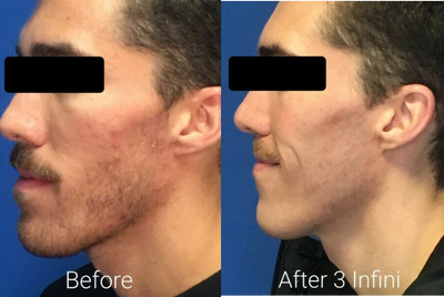 Infini RF before and after photo