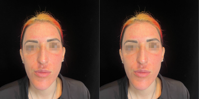 Microneedling before and after photo