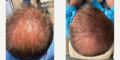 PRP for Hair Loss before and after photo