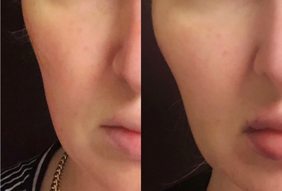 Radiesse before and after photo