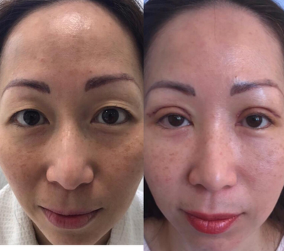 Double Eyelid Surgery before and after photo