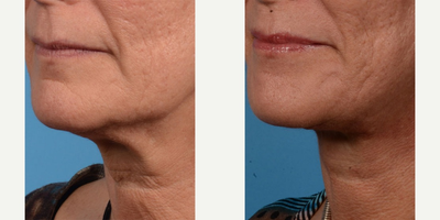 SMAS Facelift before and after photo