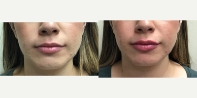 Volbella before and after photo