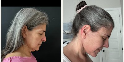 Eyelid Surgery before and after photo