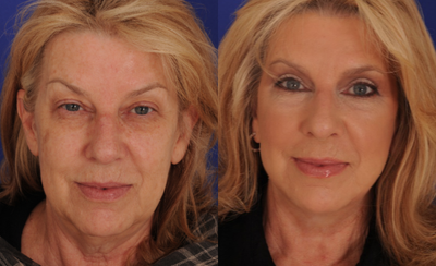 Facelift before and after photo