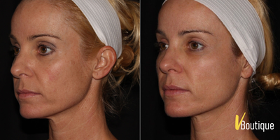 IPL before and after photo